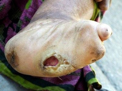 Leprosy7.jpg