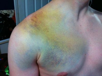 snowboarding-20bruise.jpg