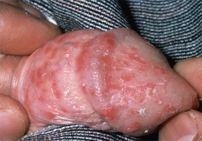 balanitis-candida.jpg