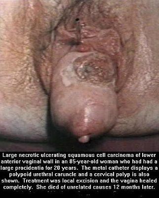 large-necrotic.jpg