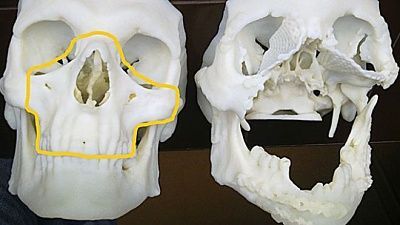 polandfacetransplant.jpg