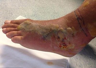 snake-bite-5.jpg