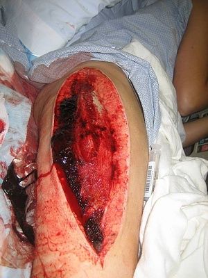 incision-20to-20relieve-20compartment-20syndrome.jpg