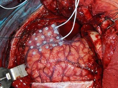 brain-20during-20surgery.jpg
