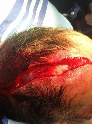 deep-20forehead-20gash.jpg