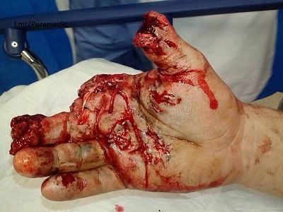 firworks-20accident.jpg