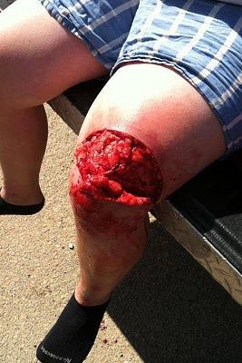 knee-20tear.jpg
