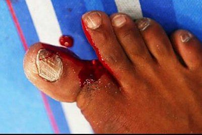 broken-toe.jpg
