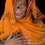 bashiran-bibi-acid-attack-victim1-150x150.jpg