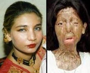 254428-pakistani-acid-attack-victim-fakhra-younus-committed-suicide-in-italy1-300x242.jpg