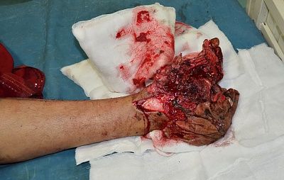 foot-20crushed-20by-20train.jpg