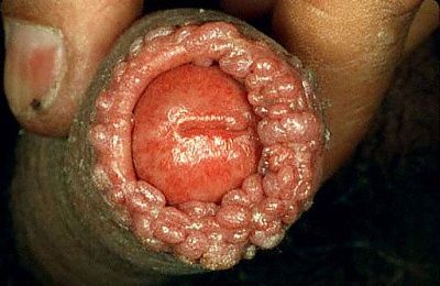 genital_warts_01.jpg