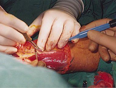 phalloplasty2.jpg