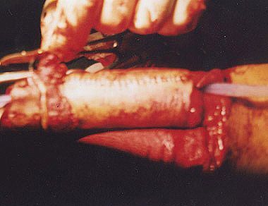 phalloplasty6.jpg