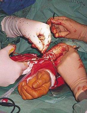 phalloplasty5.jpg