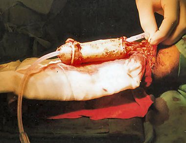 phalloplasty8.jpg