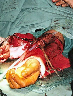 phalloplasty7.jpg