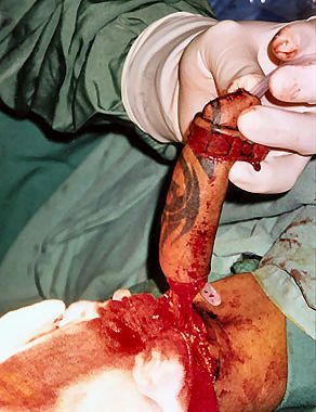 phalloplasty9.jpg