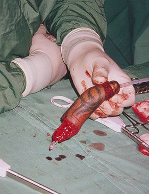 phalloplasty10.jpg