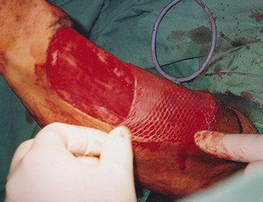 phalloplasty12.jpg