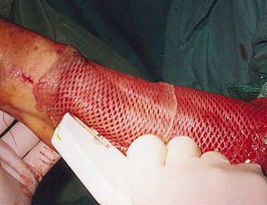 phalloplasty13.jpg