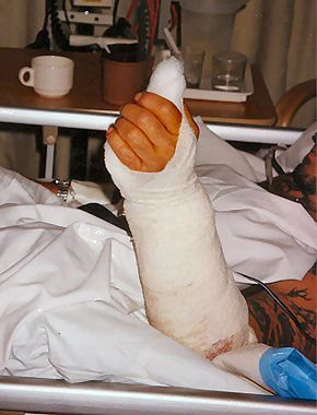 phalloplasty14.jpg