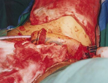 phalloplasty16.jpg