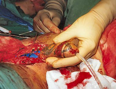 phalloplasty17.jpg