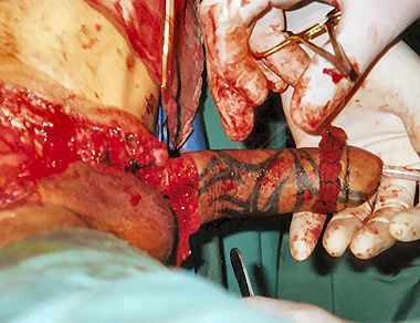 phalloplasty18.jpg