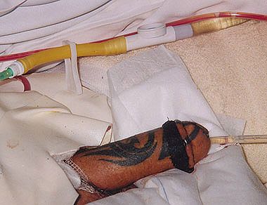 phalloplasty20.jpg