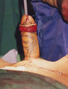 phalloplasty19.jpg