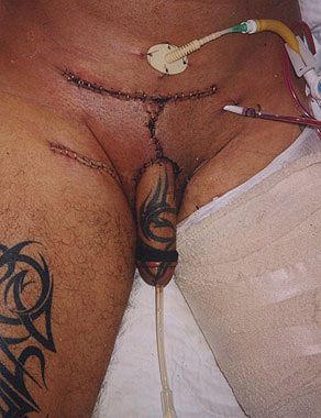 phalloplasty23.jpg