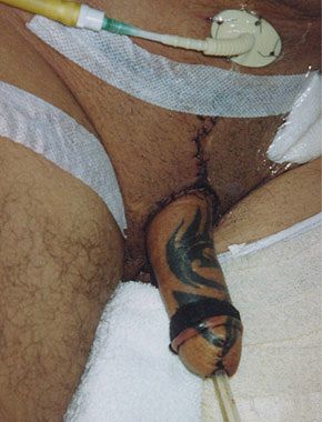 phalloplasty24.jpg