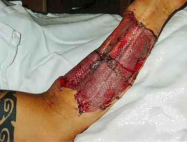 phalloplasty25.jpg