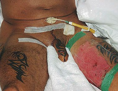 phalloplasty26.jpg