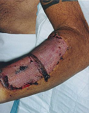 phalloplasty28.jpg