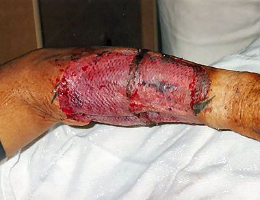 phalloplasty29.jpg