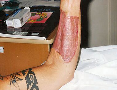 phalloplasty31.jpg