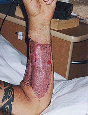 phalloplasty30.jpg