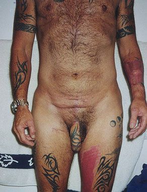 phalloplasty32.jpg