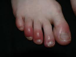 chilblains.jpg