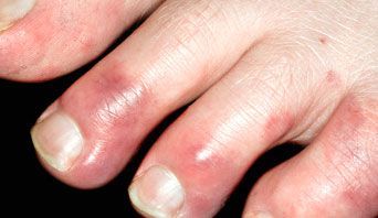 chilblains4.jpg
