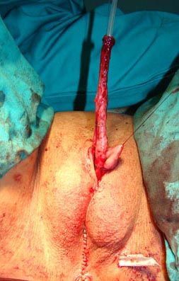 Total_phalloplasty_in_FTM_patient3_001.jpg