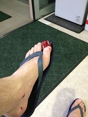 foot-20injury-20-281-29.jpg