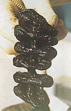 impactedcolon.jpg