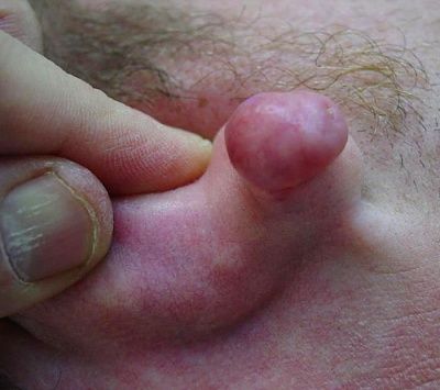ear-keloid-3.jpg