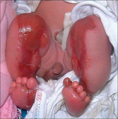 aplasia1.jpg