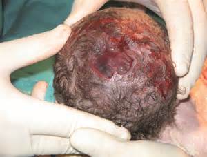 aplasia4.jpg