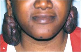 keloid.jpg