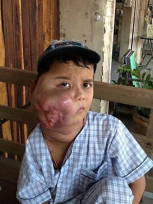goiter.jpg